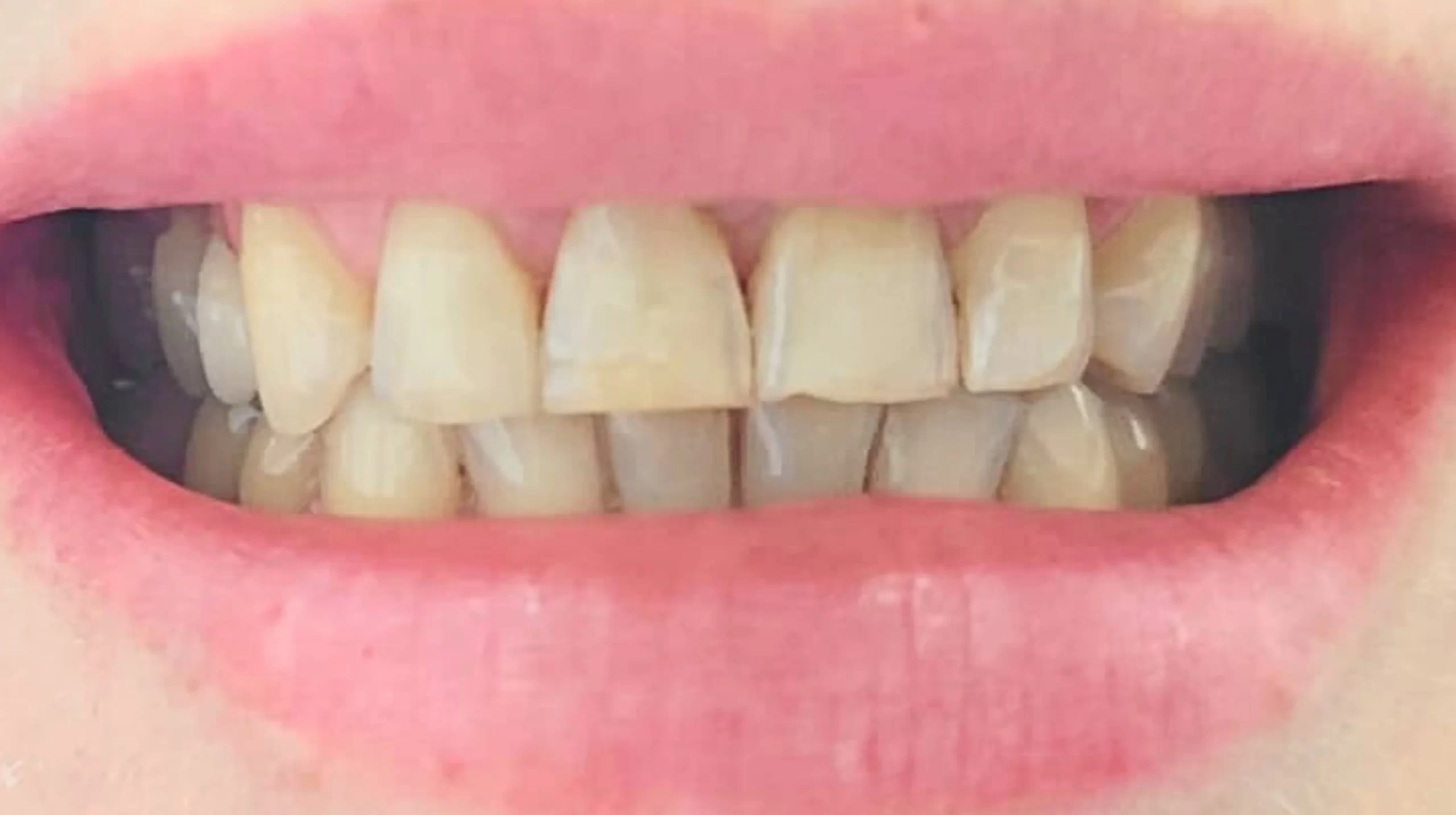 Faccette-dentali1_prima-scaled-1 Faccette-dentali1_prima-scaled-1
